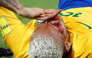 Chùm ảnh: Neymar chảy máu lênh láng trong chiến thắng '5 sao' của Brazil