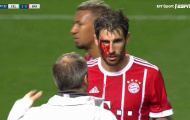 Javi Martinez đổ máu giúp Bayern giật 3 điểm rời Scotland
