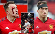 Phil Jones 'đổ máu' là tấm gương cho các cầu thủ Man Utd thời điểm này