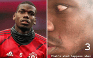 Va chạm trên sân tập, Pogba 'trầy da tróc vẩy' trước Lindelof