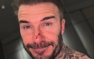 David Beckham bị con gái cắn xước mũi