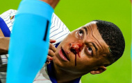 Rõ tình trạng Mbappe sau pha va chạm kinh hoàng