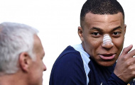 Lộ hình ảnh đầu tiên của Mbappe sau khi gãy mũi
