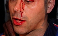Đổ máu sau trận Klitschko – Chisora