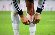 Ronaldo bị chảy máu, Real lo sốt vó
