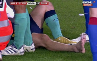 Sau gần 2 năm, Messi mới dính chấn thương