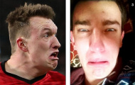 'Hội chứng Phil Jones' lan truyền khắp thế giới
