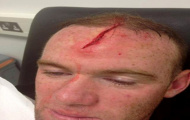 SỐC: Wayne Rooney 'khoe' chấn thương khủng khiếp trên Facebook