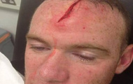 Rooney để lộ vết thương như 'phim kinh dị'