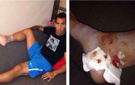 Tevez bức xúc vì suýt vỡ mắt cá chân
