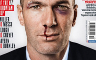 Zidane bị đánh bầm mắt và ăn sẹo