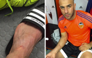 Hậu vệ Valencia tung bằng chứng tố Luis Suarez chơi xấu