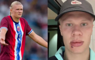Haaland khâu 3 mũi vì tai nạn hy hữu, hài hước gọi Odegaard là “thủ phạm”