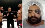 Cú đấm khiến võ sĩ MMA rạn xương mặt