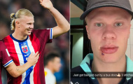 Haaland kể chuyện 'dở khóc dở cười', bị cửa xe buýt đánh vào mặt trước trận derby Manchester