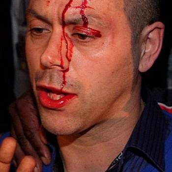 Đổ máu sau trận Klitschko – Chisora